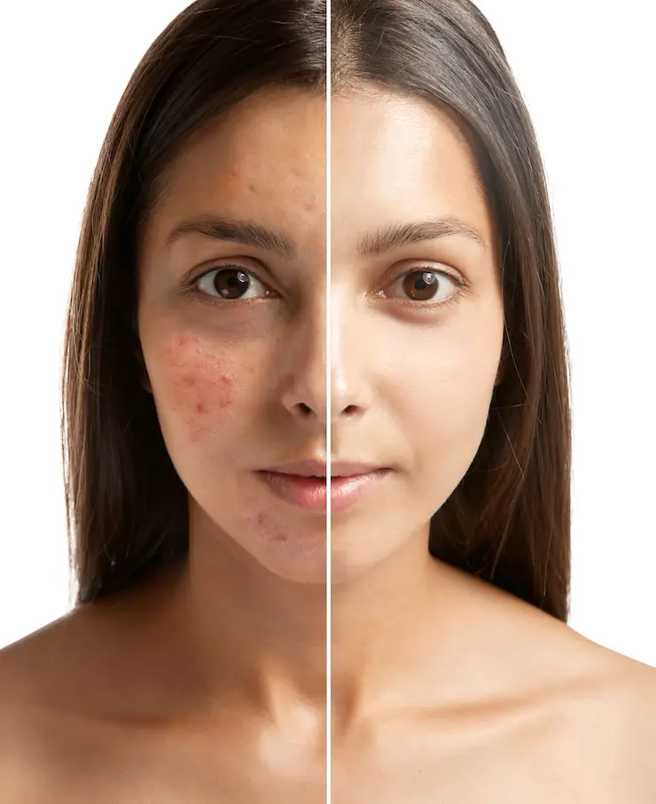 7 Home Remedies For Acne & Pimples 