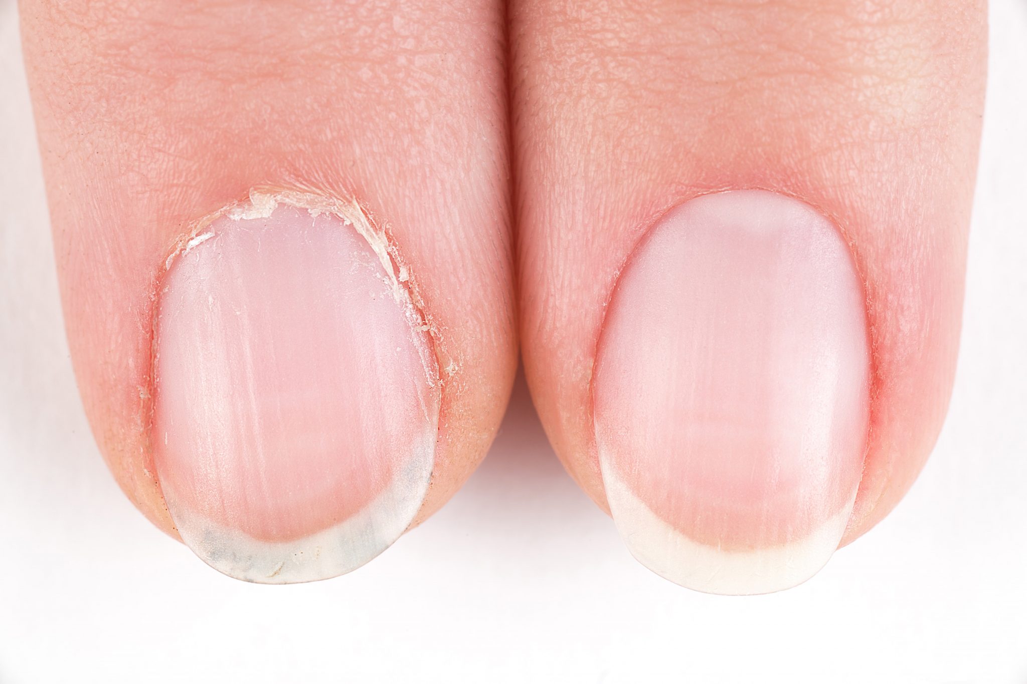 How to heal cuticles overnight?